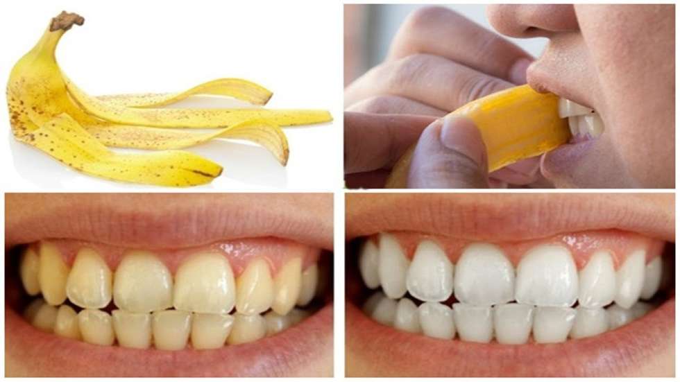 Comment Blanchir Les Dents Avec Des Pelures De Banane