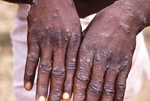 272 personnes en cours de suivi en Côte d'Ivoire, après un contact avec le virus du mpox